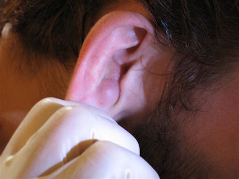 Martin's Ear Cyst | Flickr - Photo Sharing!