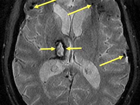 Diffuse Axonal Injury (DAI) - MRI Online