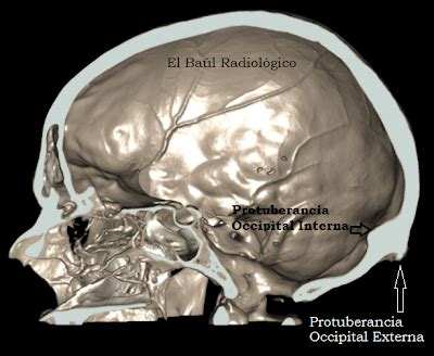 El Baúl Radiológico: PROTUBERANCIA OCCIPITAL EXTERNA (Ossified Spur on ...