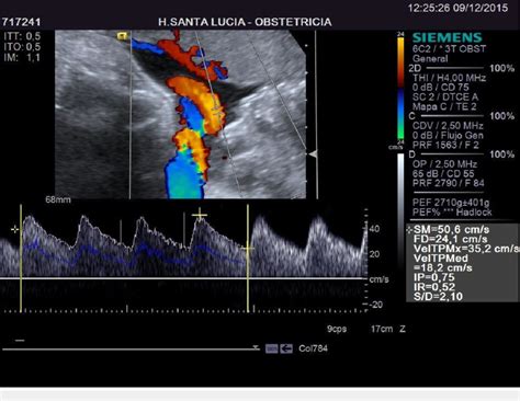 Umbilical Artery Doppler in Week 35 | Download Scientific Diagram