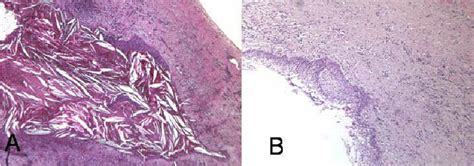 Lateral Periodontal Cyst Histology