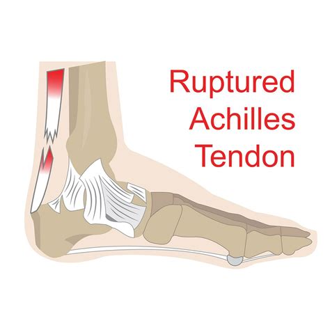 Achilles Rupture: Surgical versus non-surgical treatment | Complete Physio