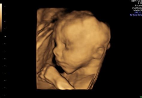 Elite Ultrasound | Elite Ultrasound | 3D Baby Scan | East Kilbride ...