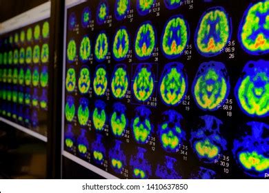 Pet Ct Scan Human Brain Axial Stock Photo 1410637850 | Shutterstock