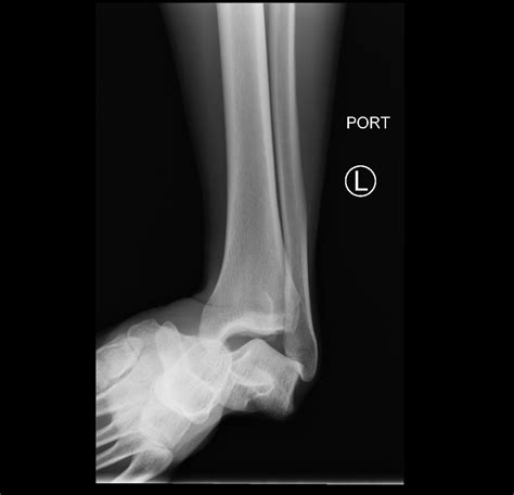 Medial Subtalar Dislocation: A Case Report - JETem