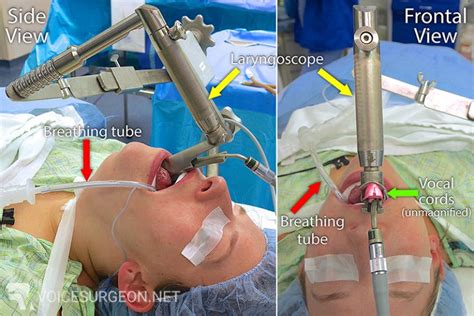 Microlaryngoscopy - Microlaryngoscopy with Biopsy - Voice Surgeon