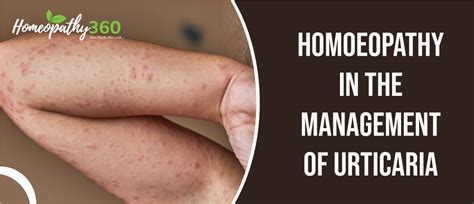 Hives (Urticaria): Causes, Pictures, Symptoms and Treatment with Homeopathic Medicine