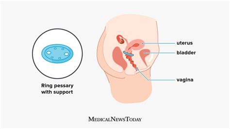 Bladder Prolapse Pessary