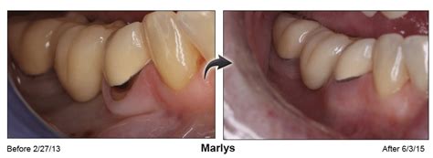 Pinhole® Surgical Technique - Pacific Smiles Dental Implant Center