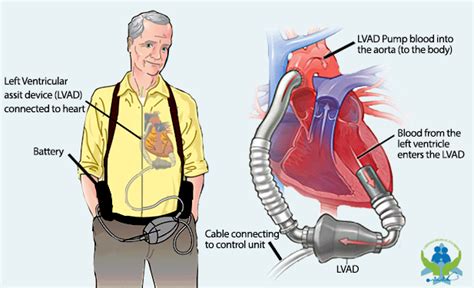 Left Ventricular Assist Device (LVAD)