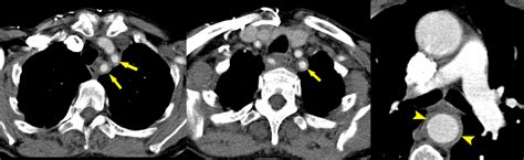 Giant Cell Arteritis – CT - Radiology at St. Vincent's University Hospital