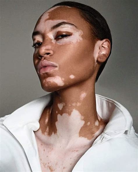 Cover Girl Features First Vitiligo Model In Ad Campaign