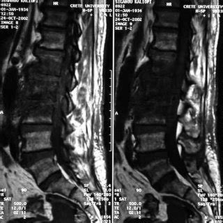 -MRI showing the epidural abscess pre op | Download Scientific Diagram