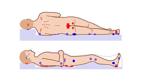 Pressure Sores - StoryMD