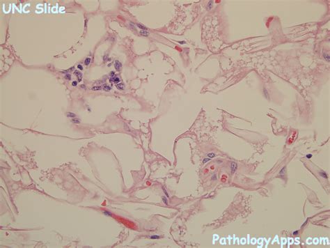 hibernoma pathology