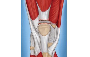 Quadriceps Tendon Tear - OrthoInfo - AAOS