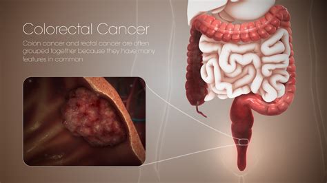 Colorectal cancer: Symptoms, Causes, and Treatment - Scientific Animations