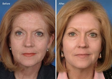 Laser Skin Resurfacing: What It Is, How It Works, Side Effects & Cost