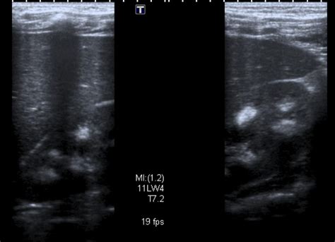 Medullary nephrocalcinosis: Ultrasound - Sumer's Radiology Blog