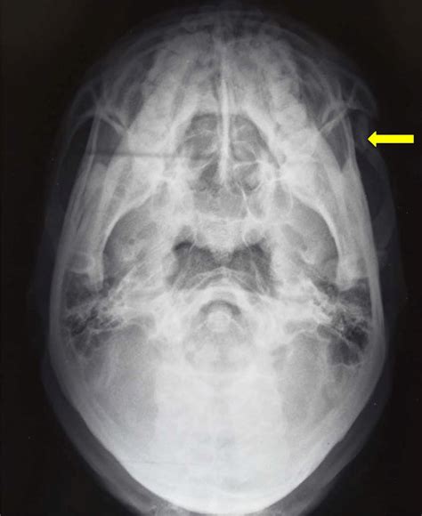 Zygomatic Arch Radiograph