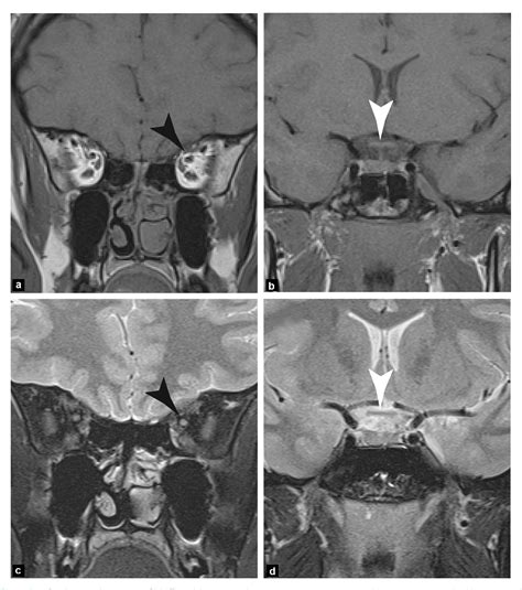 Figure 1 from Imaging of the pre-chiasmatic optic nerve. | Semantic Scholar