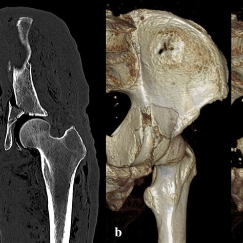 Hip Fracture Ct Scan