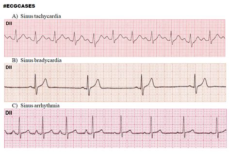 Sinus tachycardia vs Sinus bradycardia vs Sinus arrhythmia