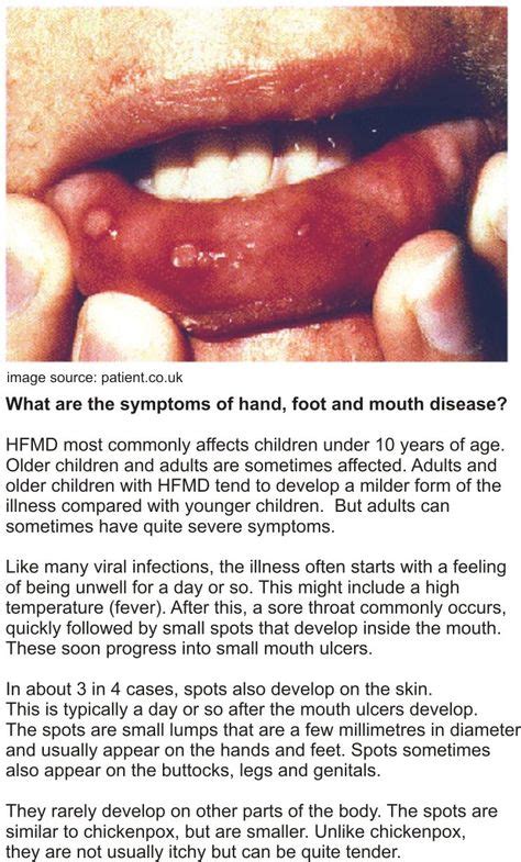 Symptoms Of Hand Foot Mouth