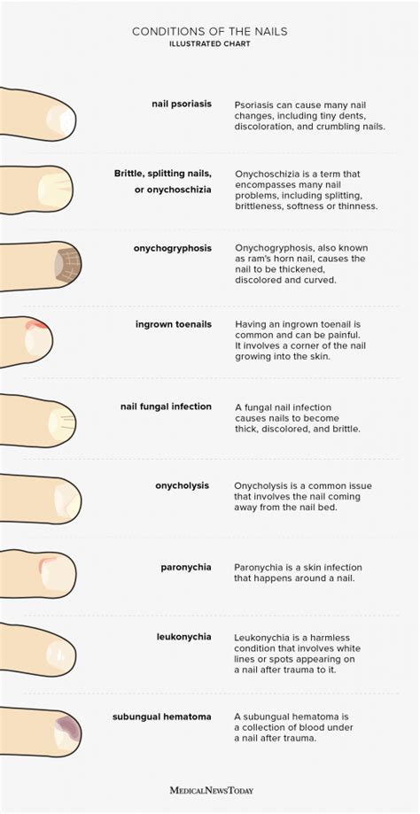 Nail health chart: Common problems and how to treat them