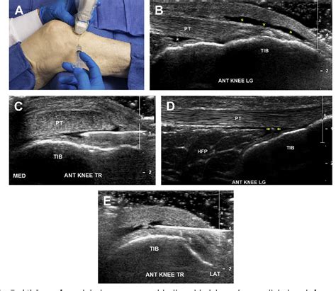 Figure 8 from Ultrasound-Guided Knee Procedures. | Semantic Scholar