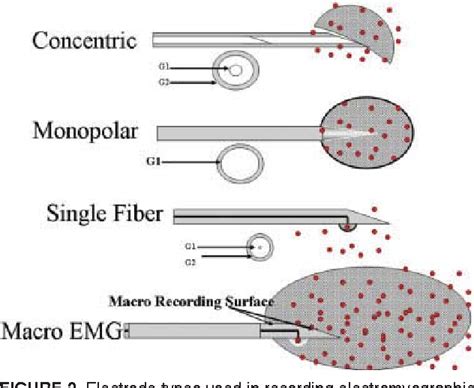 Figure 17 from Needle electromyography. | Semantic Scholar