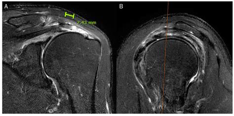 Mri Shoulder Tear