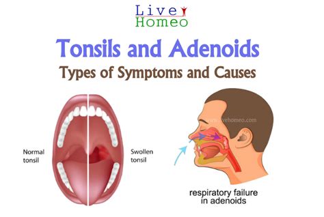 Tonsils and Adenoids – Types of Symptoms and Causes – Live Homeo