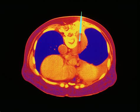 Coloured Ct Scan Showing A Lung Biopsy Photograph by Mehau Kulyk/science Photo Library