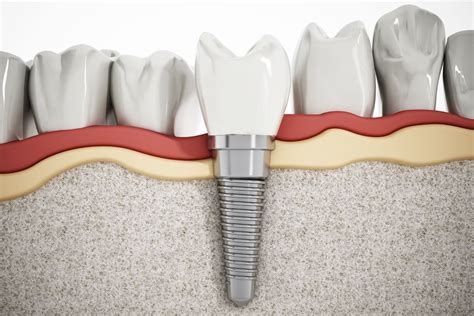 ¿Qué tipos de implantes dentales existen?