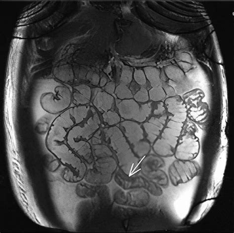 Terminal ileum thickening on magnetic resonance enterography ...