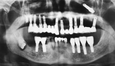 Removal of a Dental Implant Displaced Into the Maxillary Sinus After ...