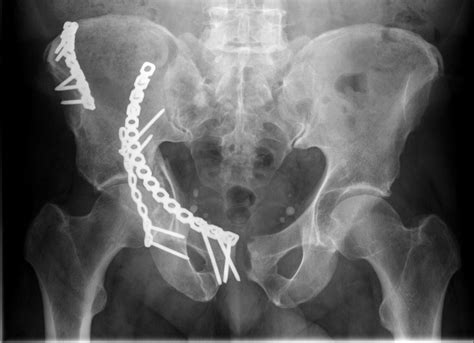 Where Does Pelvic And Acetabular Fracture Treatment Fit Into The Newly ...