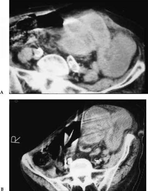 Collapsed Small Bowel Loops On Ct Scan - Small Bowel