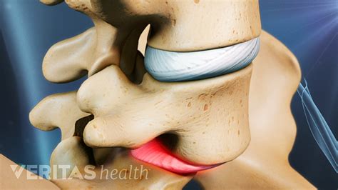 Exercise for Sciatica from Isthmic Spondylolisthesis | Spine-health