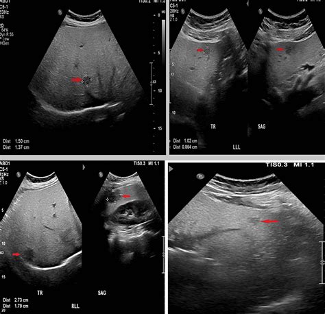 Normal Vs Fatty Liver Ultrasound