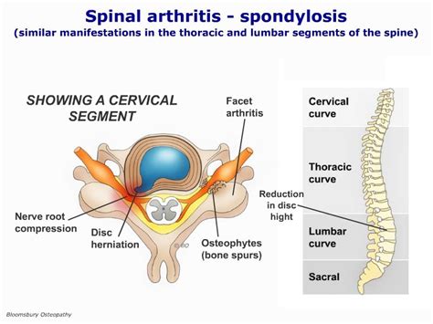 Bloomsbury Health Centre » Thoracic osteoarthritis TSPP02