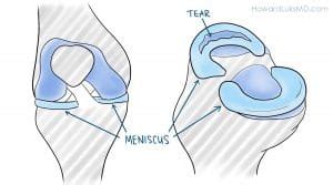 Posterior Horn Medial Meniscus Tears – Howard J. Luks, MD