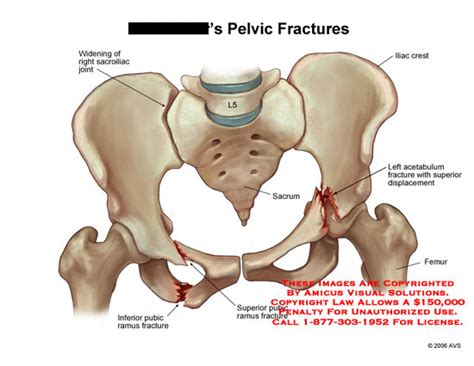 AMICUS Illustration of amicus,radiology,injury,pelvic,fracture ...