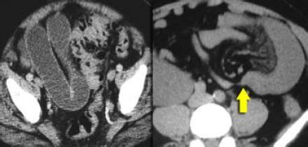 The Radiology Assistant : Closed Loop Obstruction in Small bowel ...