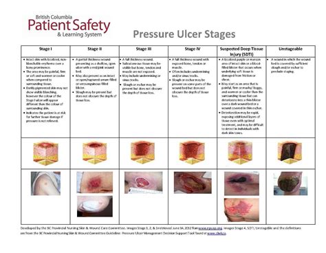 Pressure Ulcer Staging Guide | Pressure ulcer, Pressure ulcer staging, Ulcers