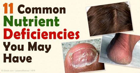 Do You Have Any of These 11 Common Nutrient Deficiencies? | Ramsey, NJ ...