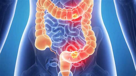 9 Symptoms of Clostridium Difficile Colitis – Entirely Health