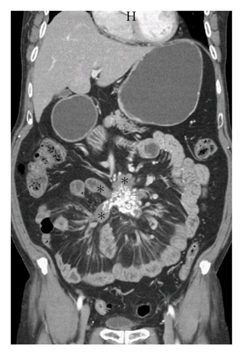 Sclerosing mesenteritis. (a) Contrast enhanced CT Axial section through ...