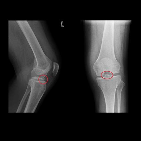 Fracture Movie - Fracture Treatment